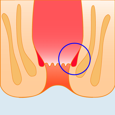 痔の保存療法のイラスト