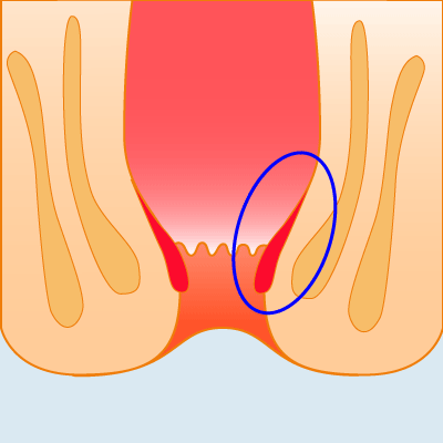 痔の四段階注射法のイラスト