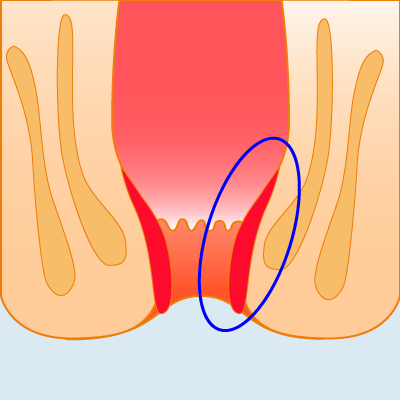 痔の四段階注射法のイラスト
