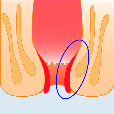 痔の常時脱出のイラスト