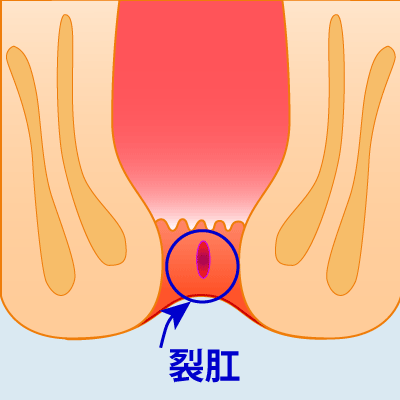 痔の裂肛のイラスト
